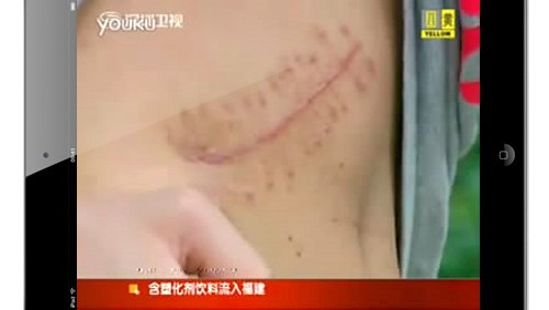 Cina: 17enne vende un rene per comprare l'iPad 2