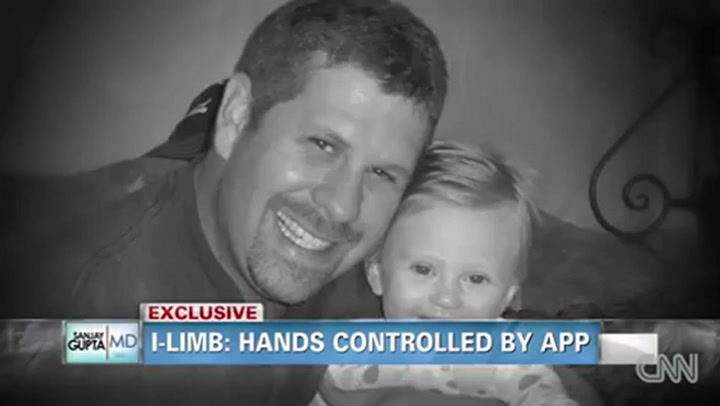 Mano bionica controllata da iPhone