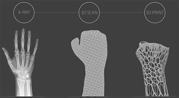Lastre ai raggi X, scansione 3D dell'arto e stampa 3D del gesso: ecco i tre step necessari