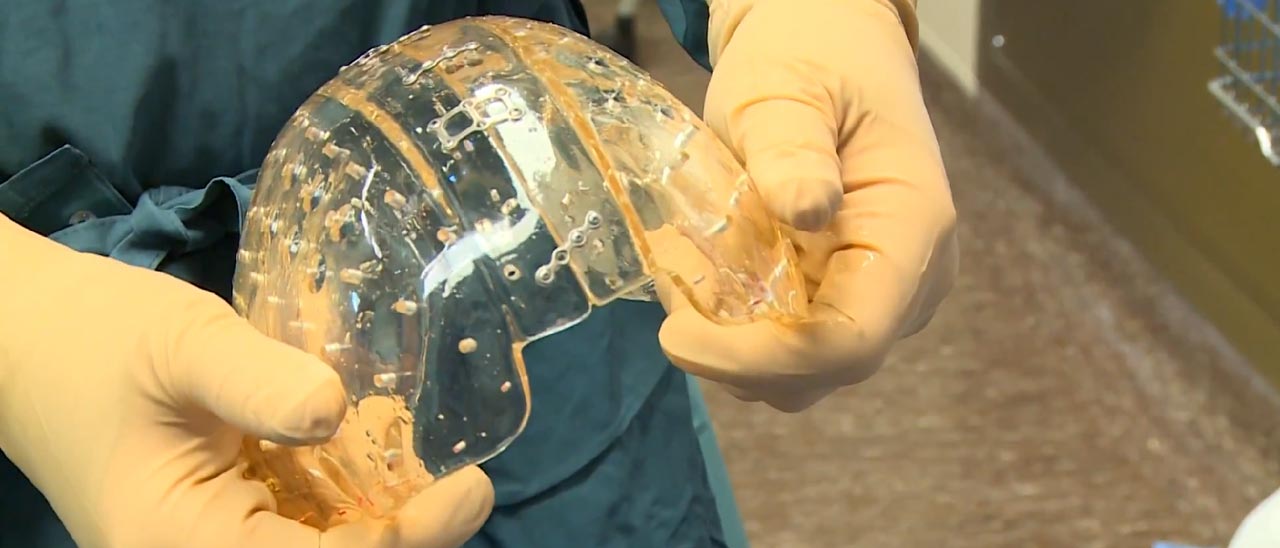 Un cranio trasparente stampato in 3D