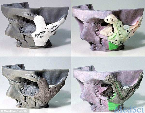 La protesi stampata in 3D e impiantata nel viso di Stephen Power