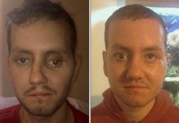 Stephen Power, prima e dopo l'intervento di ricostruzione facciale con protesi stampata in 3D