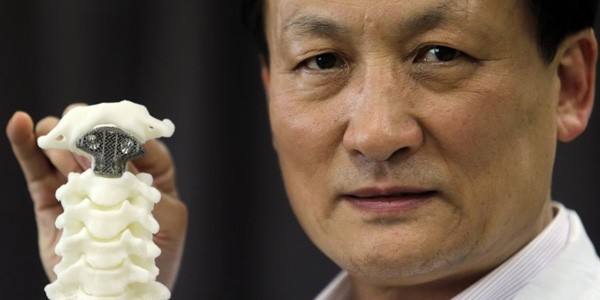 Il dottor Liu Zhongjun e la vertebra stampata in 3D utilizzata nell'intervento