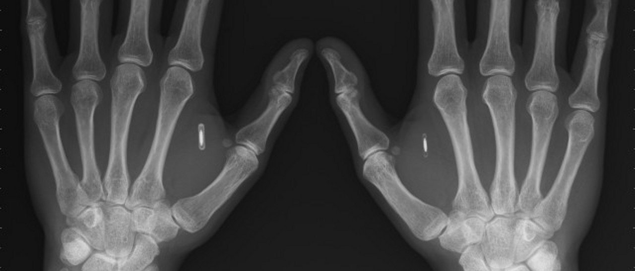 Chip NFC impiantati nelle mani con i dati Bitcoin