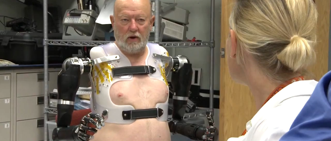Due braccia robotiche per un uomo amputato
