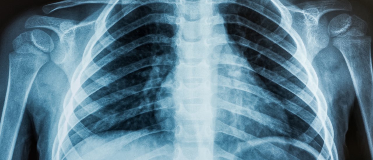 Radiografie migliori con il sensore Kinect