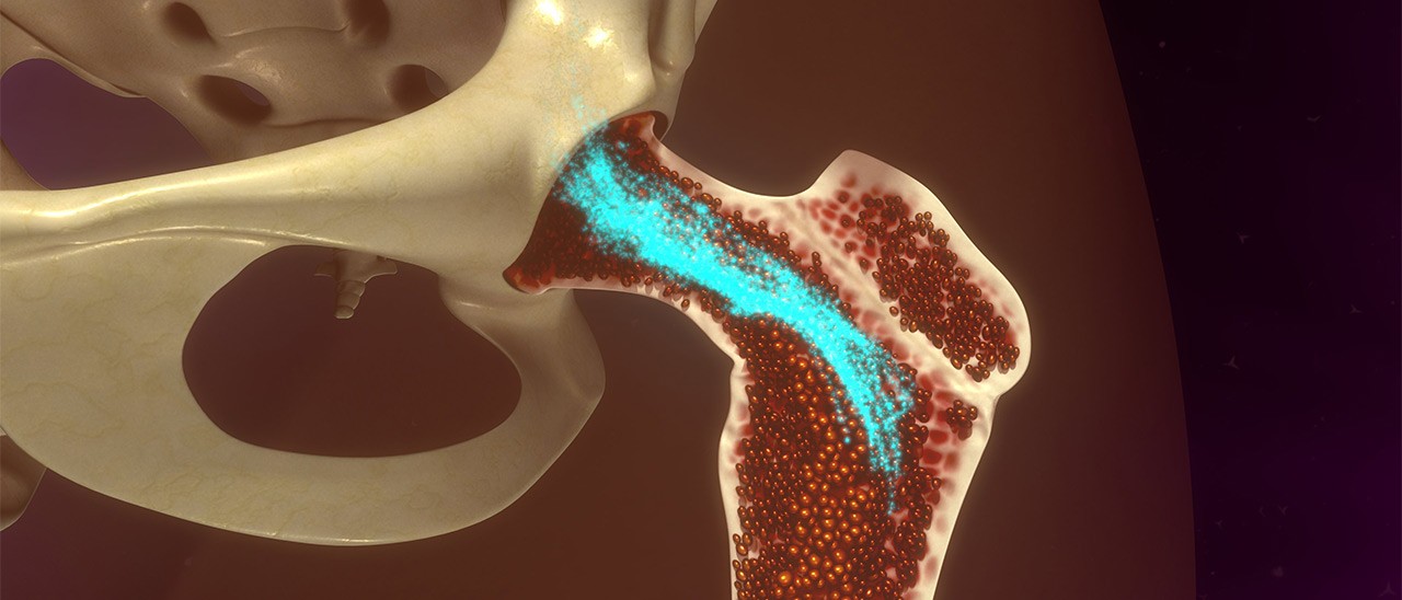 Ossa sintetiche stampate in 3D, fra cinque anni